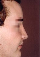 Photo of the rhinoplasty result