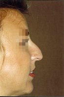 Photo of a woman with a hooked nose