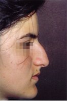 Profile photo of a woman with a prominent nasal dorsum and a hooked nose tip