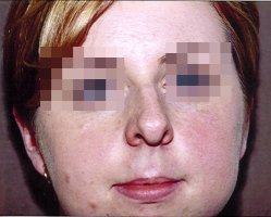 Full face photo of a patient with a bent nose