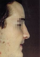 Profile photo showing a small bump on the nasal bridge