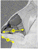 Diagram of nose tip tilt factors