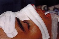 Photo of a nasal splint taped to a nose