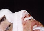 Photo showing nasal pack placed at conclusion of a rhinoplasty