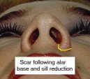 Basal view of nose showing scar after alar base and sill reduction