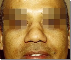 Pre-op photo of a patient with a broad nose