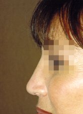 1 month post-op after implantation of a Medpor Nasal Shell