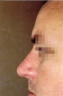 1 month post-op after implantation of a Medpor Nasal Shell