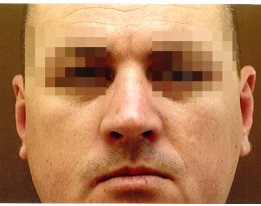 1 month post-op after implantation of a Medpor Nasal Shell