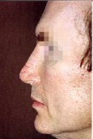 2 months post-op after removal of the rib graft and implantation of a Medpor Nasal Shell in the nose