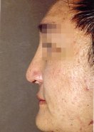 1 month post-op after implantation of a Medpor Nasal Shell in the nasal bridge and cartilage grafts in the nose tip