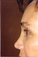 Pre-op profile photo of a patient