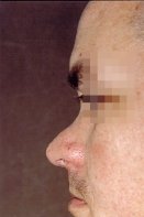 Pre-op profile photo of a patient