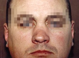 Pre-op facial photo of the patient