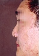 Profile photo of an Asian patient who requests a larger nose