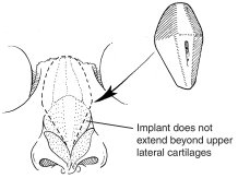 Illustration of correct placement of the Medpor Nasal Shell in the nose