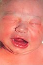 Photo of a newborn with temporary nasal deviation