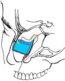 Illustration of a conservative septoplasty