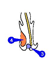 Illustration of turbinate hypertrophy