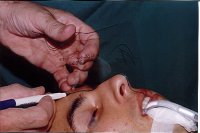 Photo of patient at commencement of rhinoplasty: marking the forehead