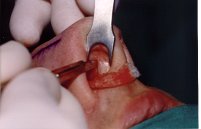 Photo illustrating incision of septal mucosa