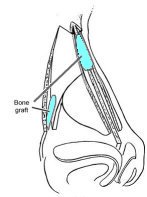 Diagram of bone grafts placed on nasal dorsum and within the lateral osteotomies