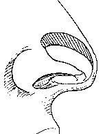 Diagram of cartilage resection from edge of tip skeleton