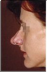 Patient's photo with planned rhinoplasty changes drawn