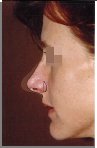 Masking a profile photograph to show rhinoplasty changes