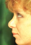 Photo of patient with supratip swelling after rhinoplasty